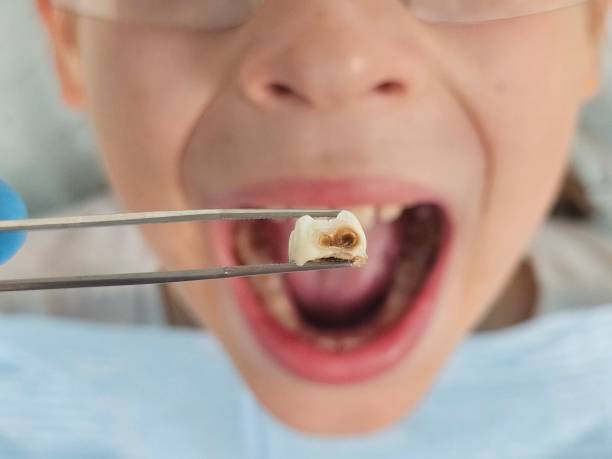 Best Broken or Chipped Tooth Repair in West Point, UT